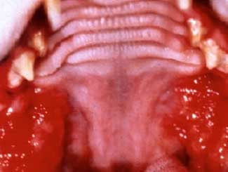 Oral and Pharyngeal Lesions