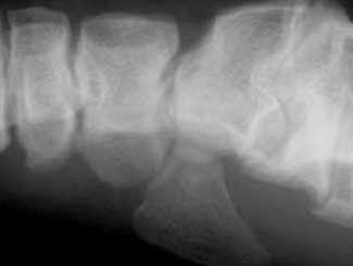 B6 - Bovine: Rickets, Osteomalacia