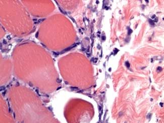 DML10 - Ferret: Inflammatory Myositis