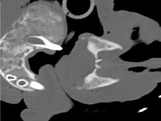 DMZ3 - Camel: Ossifying Fibroma