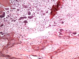 DMZ4 - Camel: Parathyroid Adenoma