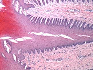 Eq14 - Equine: Coronary Band Keratoma