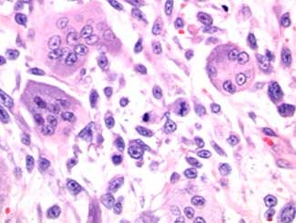 Fe11 - Feline: Giant Cell Tumor
