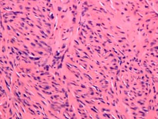 KT110 - Canine: Tendon Sheath Fibrosarcoma