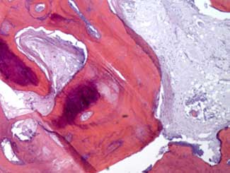 KT13 - Canine: Bone Infarct