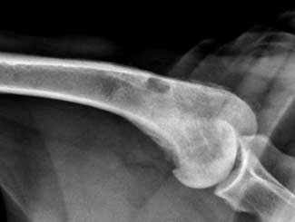 KT19 - Canine: Bone Infarct