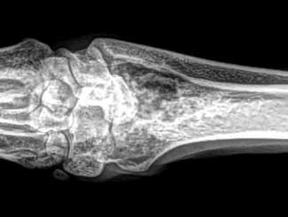 KT21 - Canine: Bone Infarct