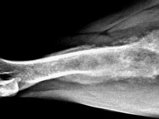 KT35 - Canine: Bone Infarct