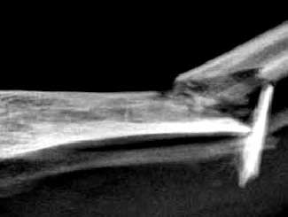 KT36 - Canine: Bone Infarct