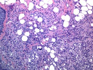 KT52 - Canine: Liposarcoma