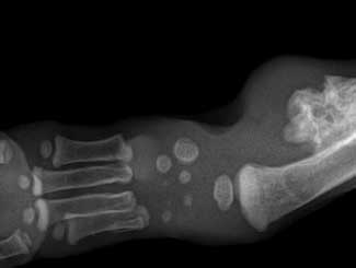 KT60 - Canine: Epiphyseal Dysplasia