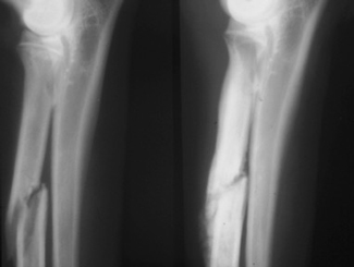 L2: Lecture - Pathology of Fracture Repair