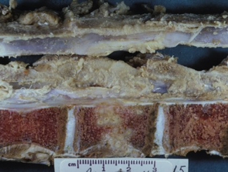 L5: Lecture - Pathogenesis of Bone Infection/Inflammation