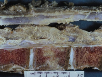 L5: Lecture - Pathogenesis of Bone Infection/Inflammation