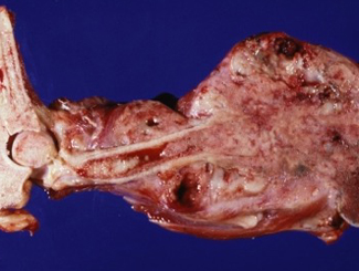 L6B: Lecture - Part 2 of 3, ntroduction to Pathology of Bone Tumors 