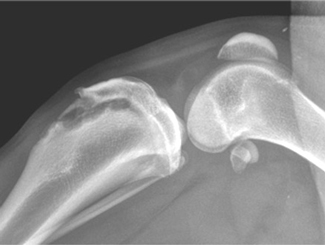 SM14: Seminar - Physeal and OCD Lesions 