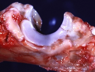 SM22: Seminar - Orthopedic Lesions from Different Categories of Bone Disease