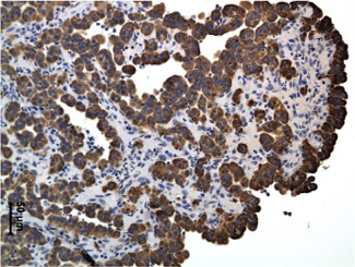 SM29: Seminar - Synovial Sarcoma Biphasic Shares IH Staining with Mesothelioma