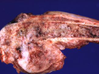 SM3: Seminar - Bone Site/Selection, Stem Cells, Their Roles in Patterns of Bone Infarcts 