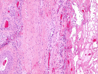 SM32: Seminar - SDFT and Suspensory Ligament Pathology