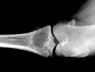 UB1: Low Grade Pleomorphic Sarcoma in Bone Infarct