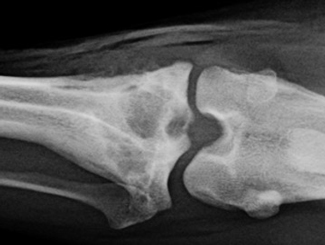 UB2: High Grade Undifferentiated Pleomorphic Sarcoma