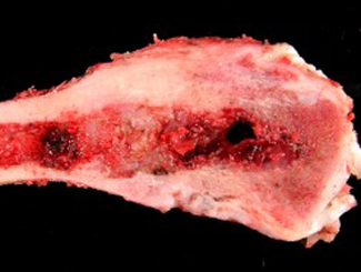 UB3: Epithelioid Osteosarcoma