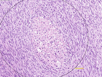 UB4: Malignant Sheath Tumor