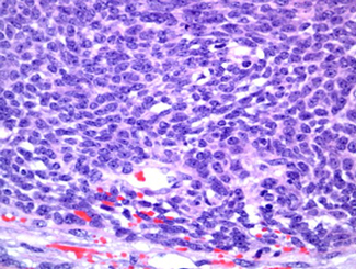 UB5: Odontogenic Carcinosarcoma 