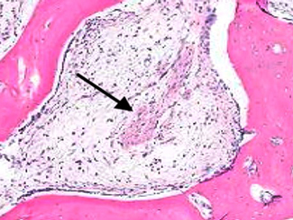 UBU2: Polyostinfarcts with Unusual Reactive Healing 