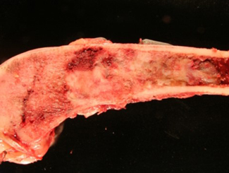 UBZ1: Zonal Bone Tumor in Bone Infarct