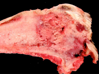 UBZ2: Zonal Bone Tumor