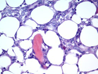 UBZ3: Zonal Bone Tumor