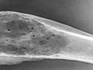 UBZ4: Zonal Bone Tumor in Bone Infarct