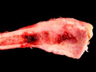 UBZ5: Zonal Epithelioid Osteosarcoma