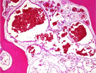 UV1: Cavernous Hemangioma in Bone Infarct Repair Site 