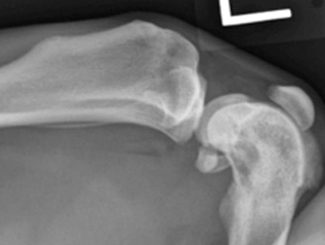 UV3: Hemangioendothelioma in Bone Infarct Repair Site 