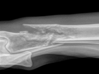 UV4: Hemangioendothelioma in Bone Infarct Repair Site 