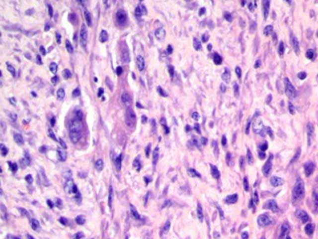 Eq35 - Equine: Pleomorphic Sarcoma Tumor