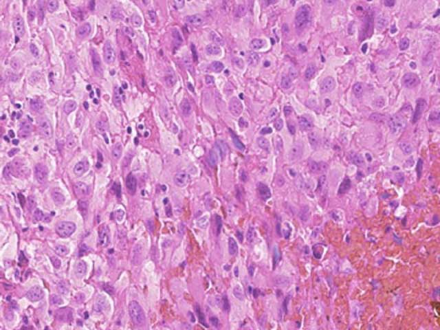 KT100 - Canine: Pleomorphic Sarcoma