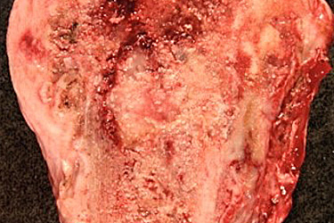 4.2 C MSC Medullary Tumors