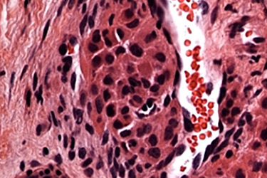 Stem - 5.1 Vascular Bone Tumors