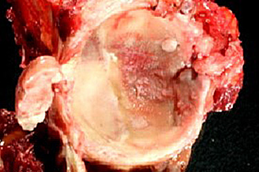 Stem - 9.1 Synovial Chondromas