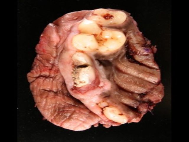 EMP - 1.3 Head Part 3 -- Dental Tumors