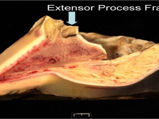 EMP - 12.1 Foot Distal IP Joint Wall