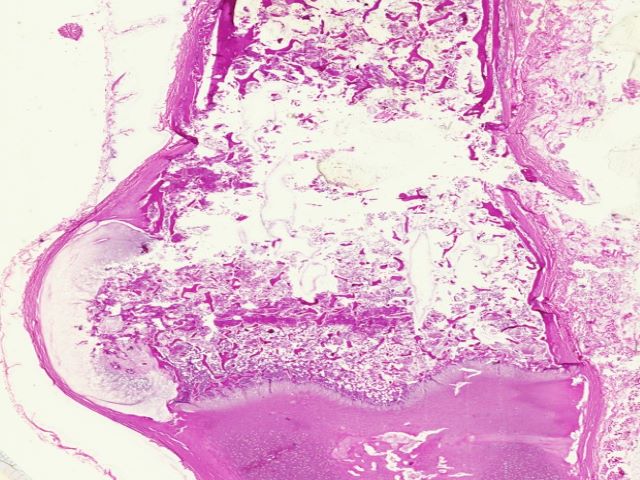 FMP - 2.1 Low Grade Bone Surface Tumors