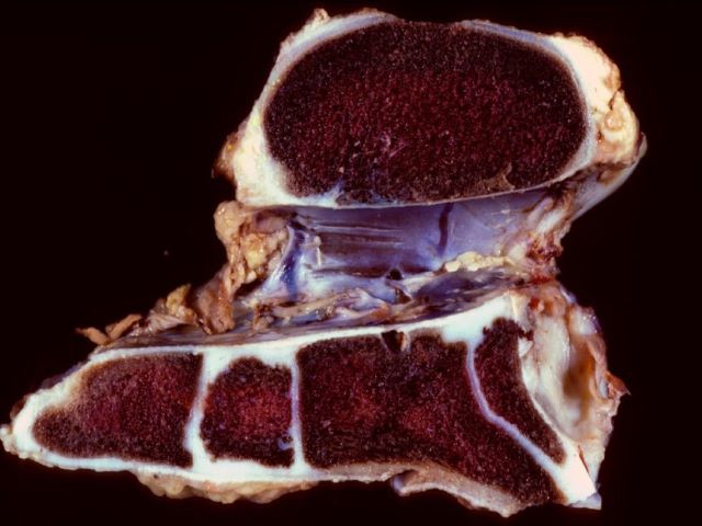 EMP - 3.1 Skeletal Development Disturbances