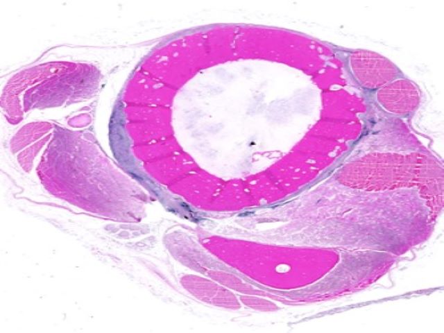 FMP - 4.3 Osteoblastic Osteosarcomas Examples