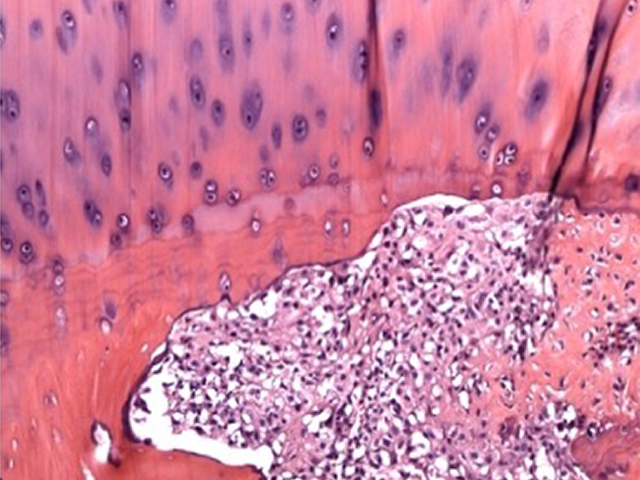 FMP - 4.3.1 Osteoblastic Osteosarcomas Examples