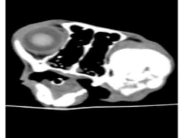 FMP - 9.1 Bone Surface Tumors